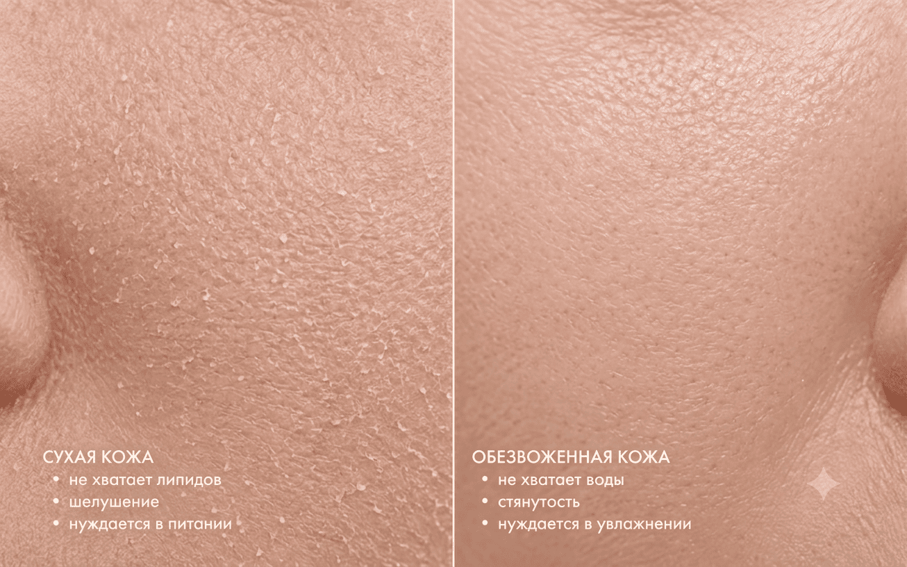 Сухая и обезвоженная кожа лица — основные отличия